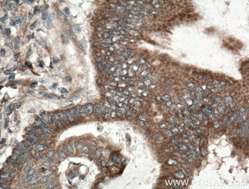 Immunohistochemistry (IHC) staining of human stomach cancer tissue using RKIP Polyclonal antibody (10575-1-AP)