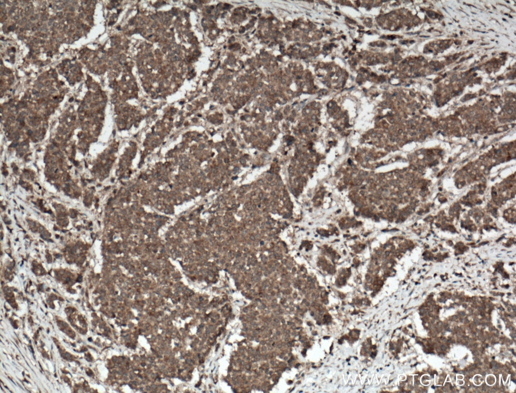 Immunohistochemistry (IHC) staining of human colon cancer tissue using RKIP Polyclonal antibody (10575-1-AP)