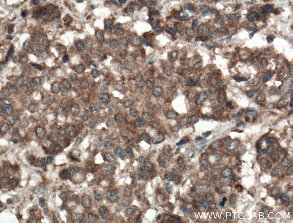Immunohistochemistry (IHC) staining of human colon cancer tissue using RKIP Polyclonal antibody (10575-1-AP)
