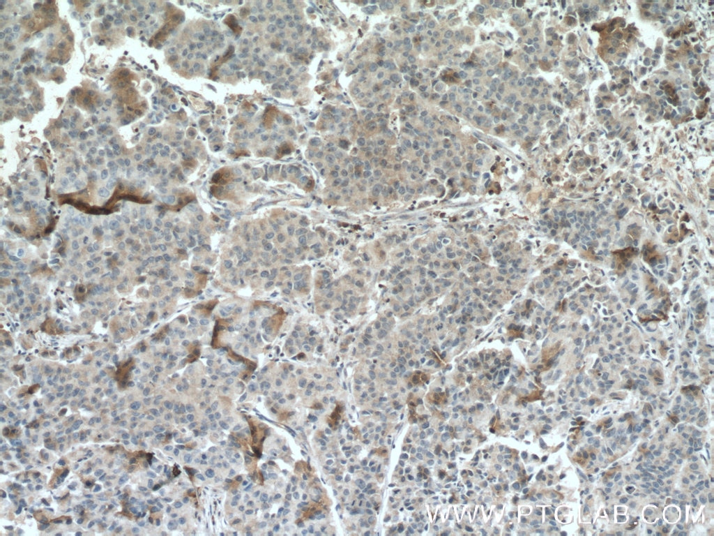 Immunohistochemistry (IHC) staining of human prostate cancer tissue using PEBP1 Monoclonal antibody (66438-1-Ig)