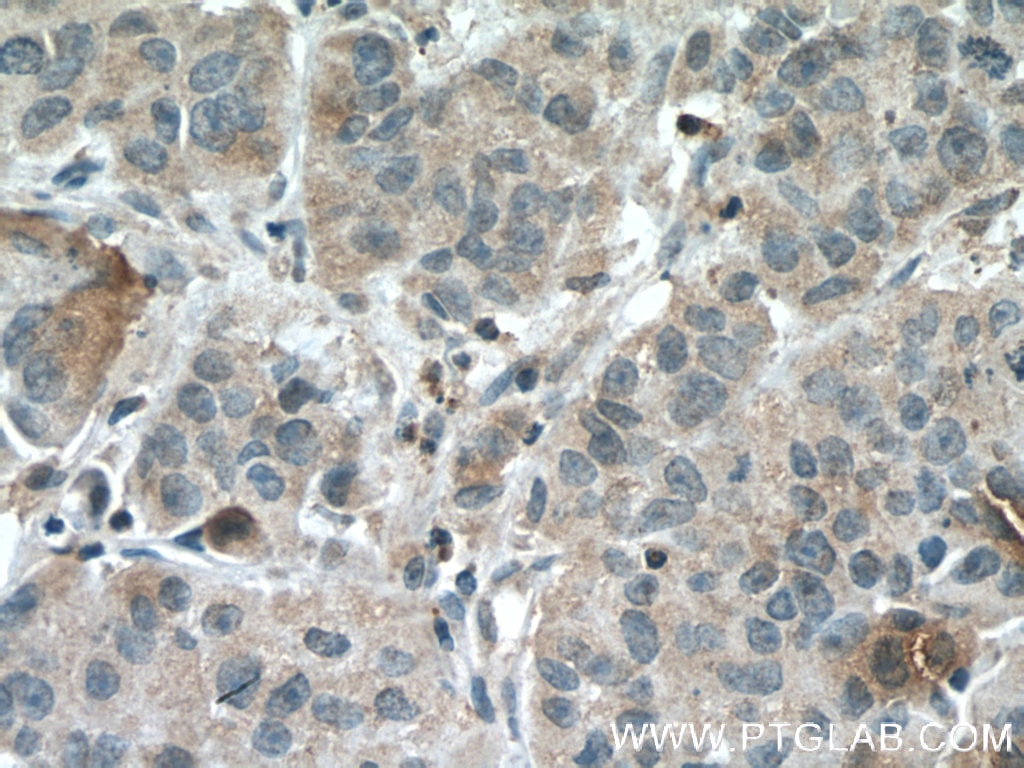 Immunohistochemistry (IHC) staining of human prostate cancer tissue using PEBP1 Monoclonal antibody (66438-1-Ig)