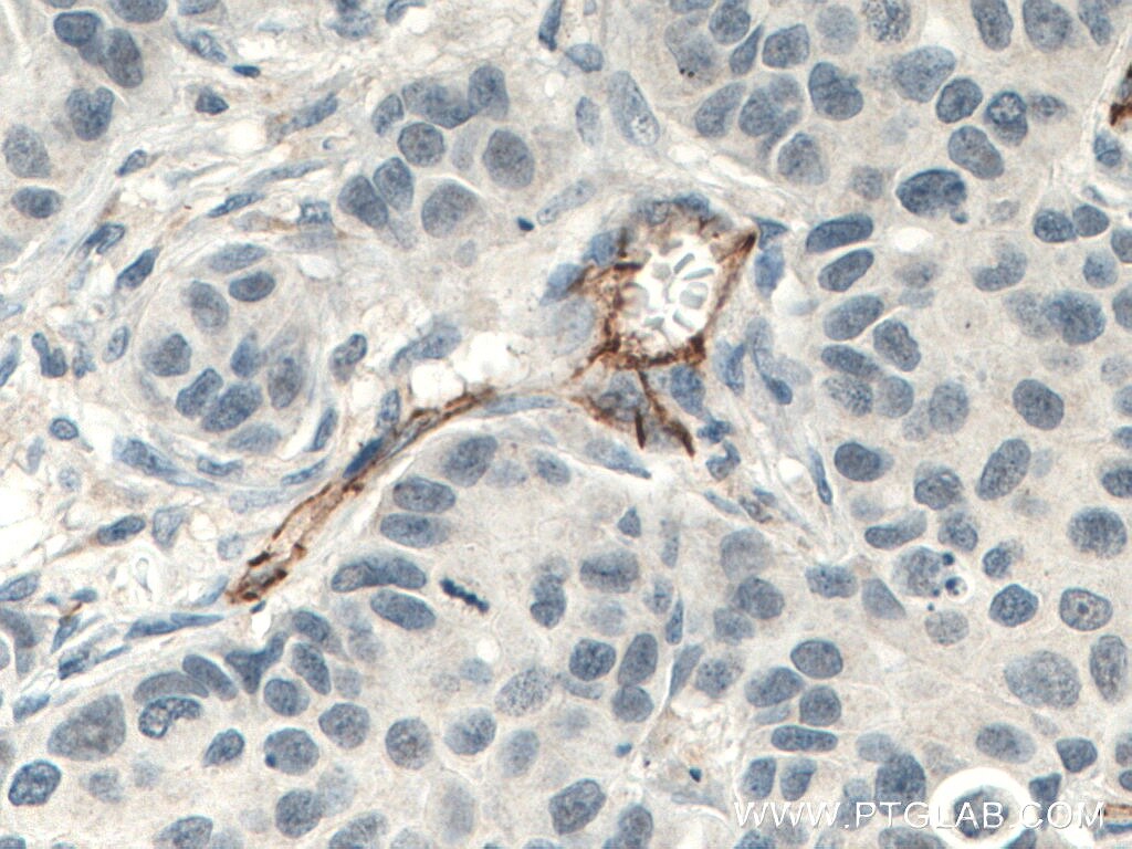 Immunohistochemistry (IHC) staining of human breast cancer tissue using CD31 Monoclonal antibody (66065-1-Ig)