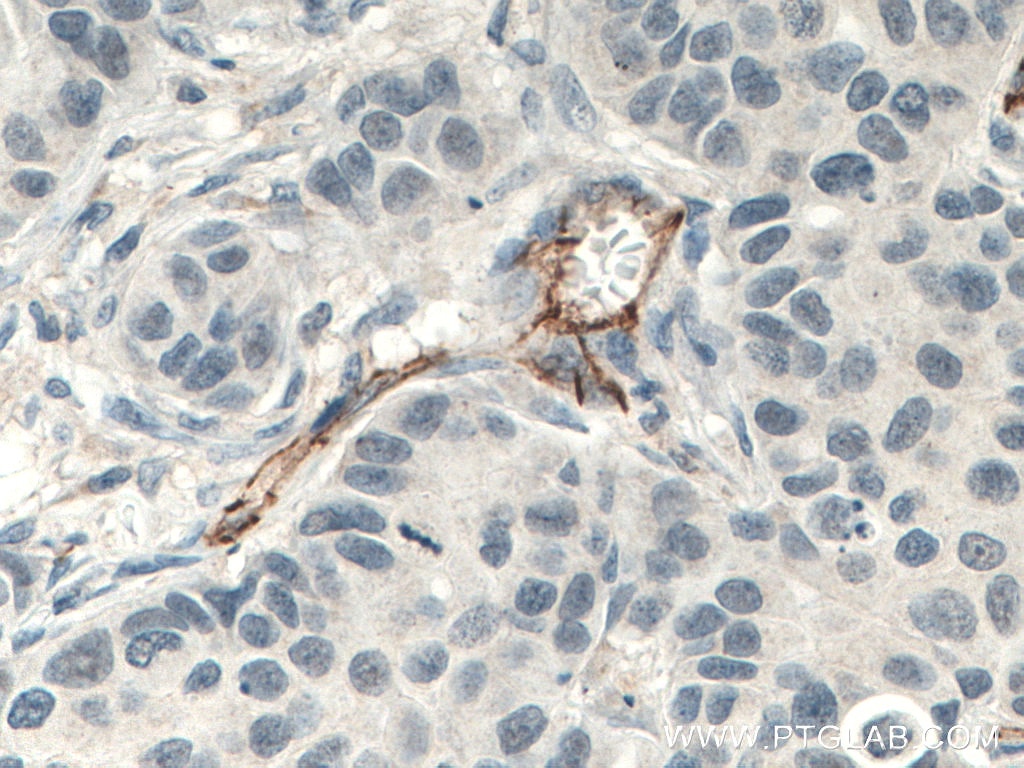 IHC staining of human breast cancer using 66065-1-Ig