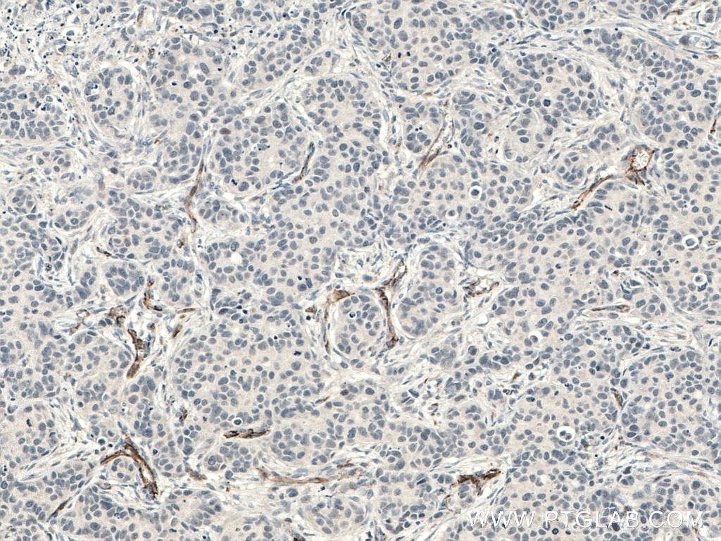 IHC staining of human breast cancer using 66065-1-Ig