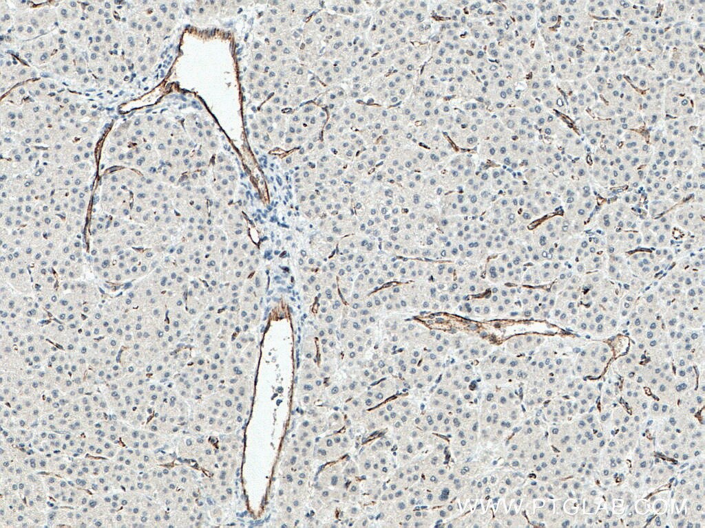 Immunohistochemistry (IHC) staining of human liver cancer tissue using CD31 Monoclonal antibody (66065-1-Ig)