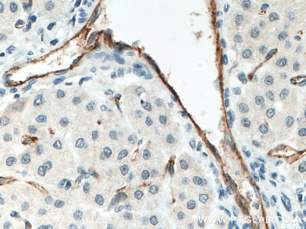 Immunohistochemistry (IHC) staining of human liver cancer tissue using CD31 Monoclonal antibody (66065-1-Ig)