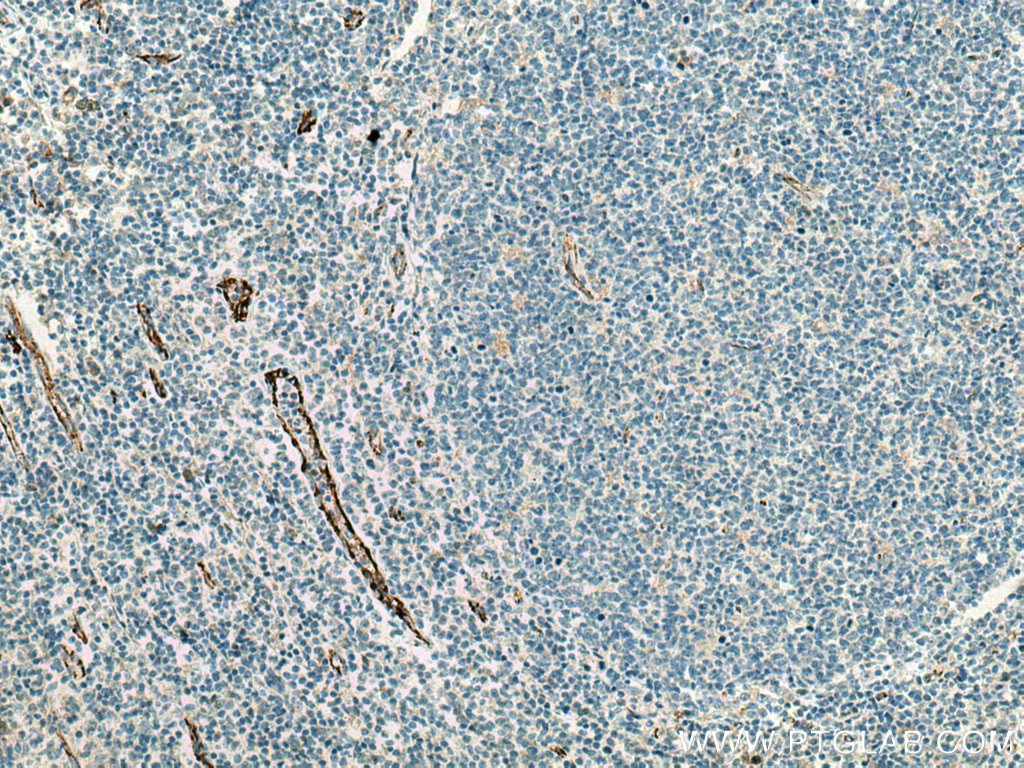 IHC staining of human tonsillitis using 66065-1-Ig