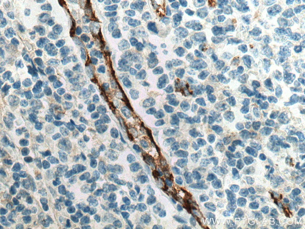 Immunohistochemistry (IHC) staining of human tonsillitis tissue using CD31 Monoclonal antibody (66065-1-Ig)