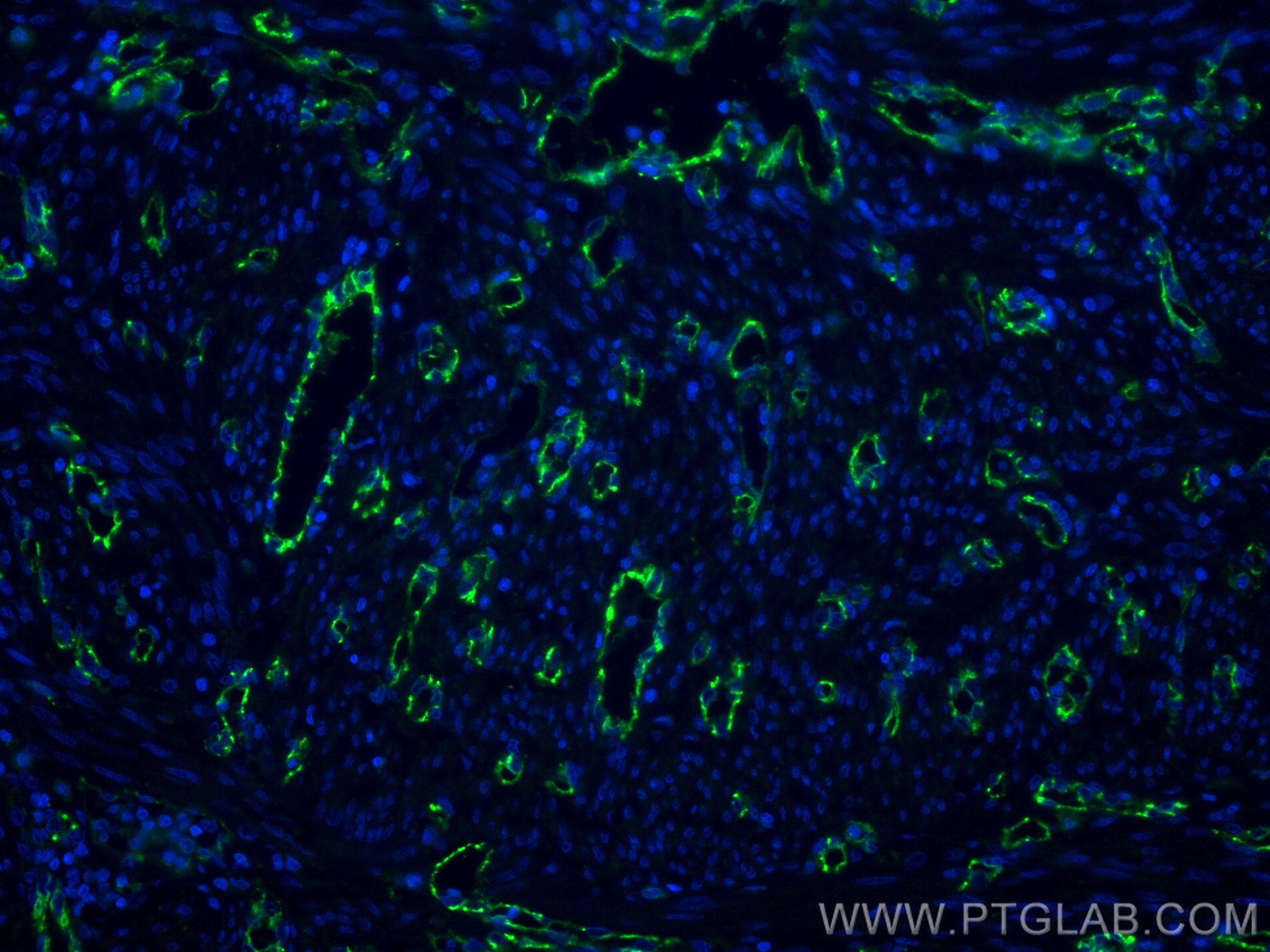 Immunofluorescence (IF) / fluorescent staining of human endometrial cancer tissue using CD31 Polyclonal antibody (11265-1-AP)