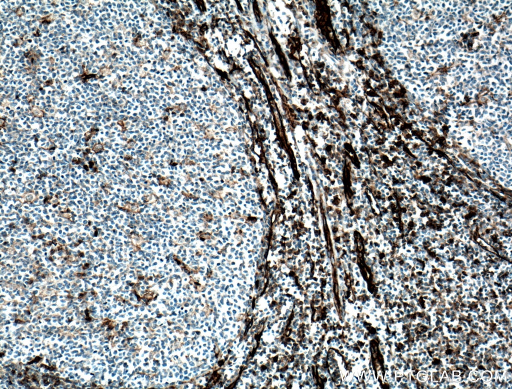 Immunohistochemistry (IHC) staining of human tonsillitis tissue using CD31 Polyclonal antibody (11265-1-AP)