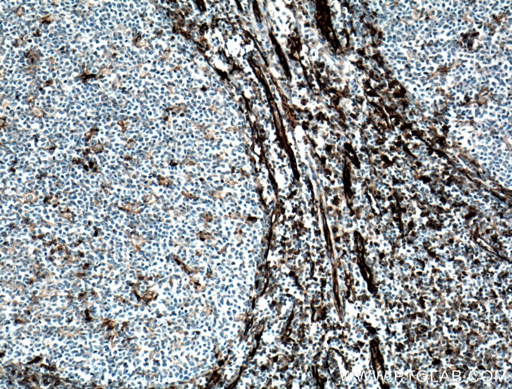 IHC staining of human tonsillitis using 11265-1-AP