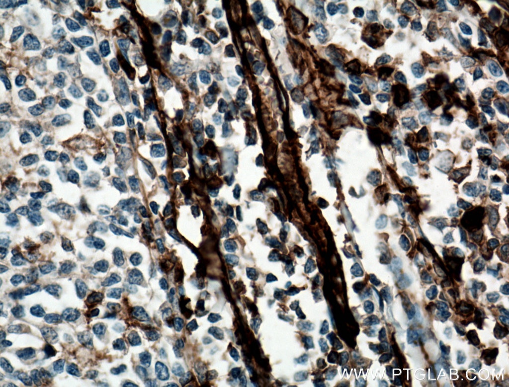 IHC staining of human tonsillitis using 11265-1-AP