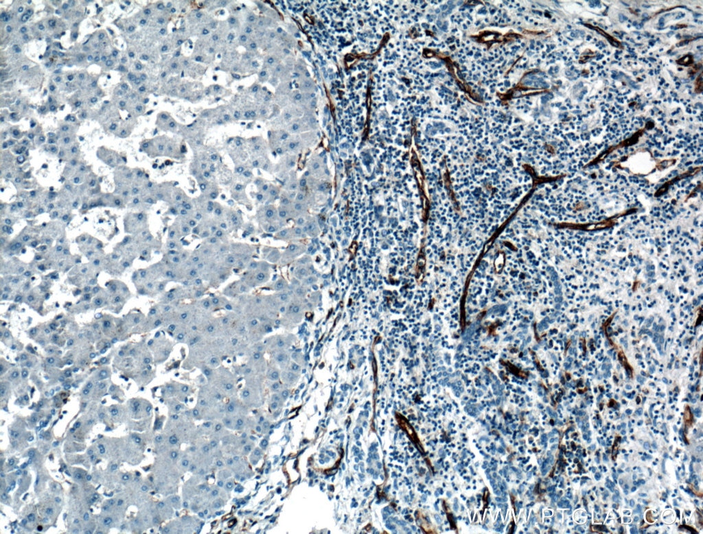 Immunohistochemistry (IHC) staining of human hepatocirrhosis tissue using CD31 Polyclonal antibody (11265-1-AP)