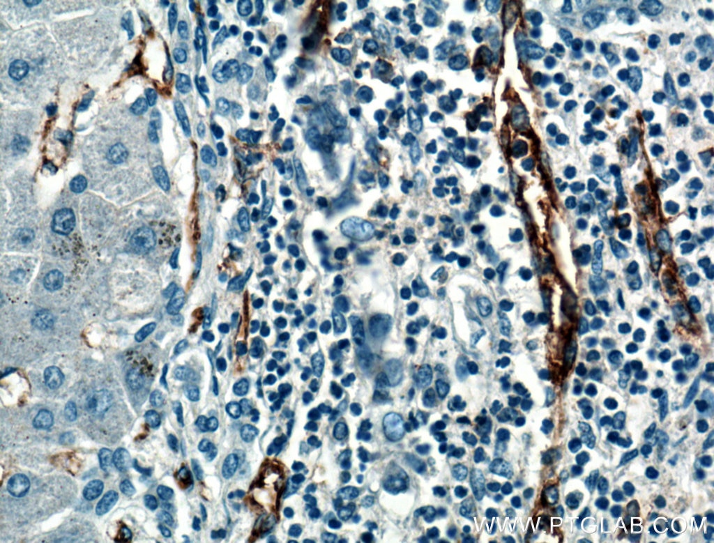 Immunohistochemistry (IHC) staining of human hepatocirrhosis tissue using CD31 Polyclonal antibody (11265-1-AP)