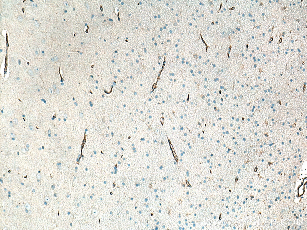 IHC staining of human gliomas using 11265-1-AP