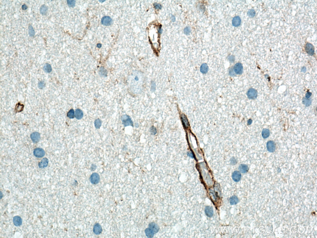 Immunohistochemistry (IHC) staining of human gliomas tissue using CD31 Polyclonal antibody (11265-1-AP)