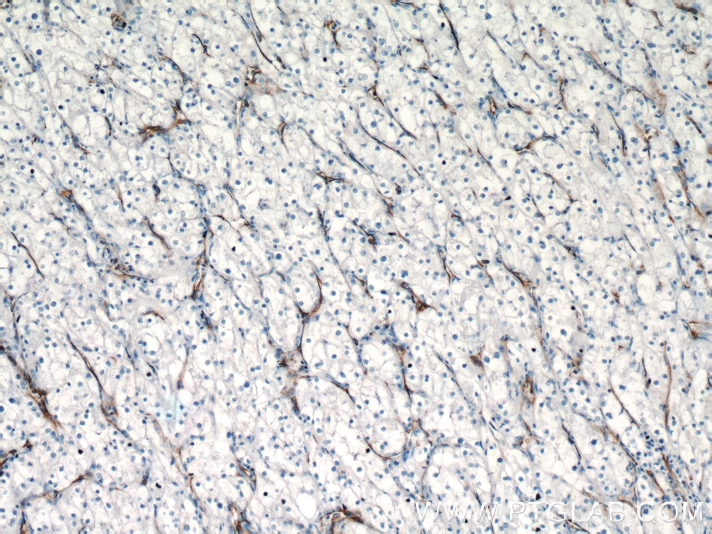 IHC staining of human renal cell carcinoma using 11265-1-AP