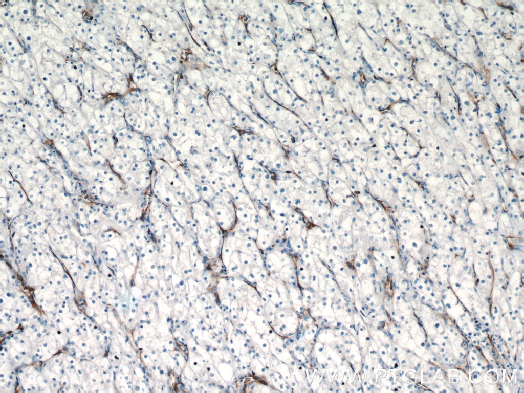 Immunohistochemistry (IHC) staining of human renal cell carcinoma tissue using CD31 Polyclonal antibody (11265-1-AP)