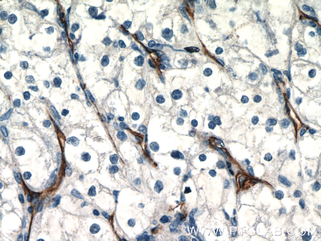 Immunohistochemistry (IHC) staining of human renal cell carcinoma tissue using CD31 Polyclonal antibody (11265-1-AP)