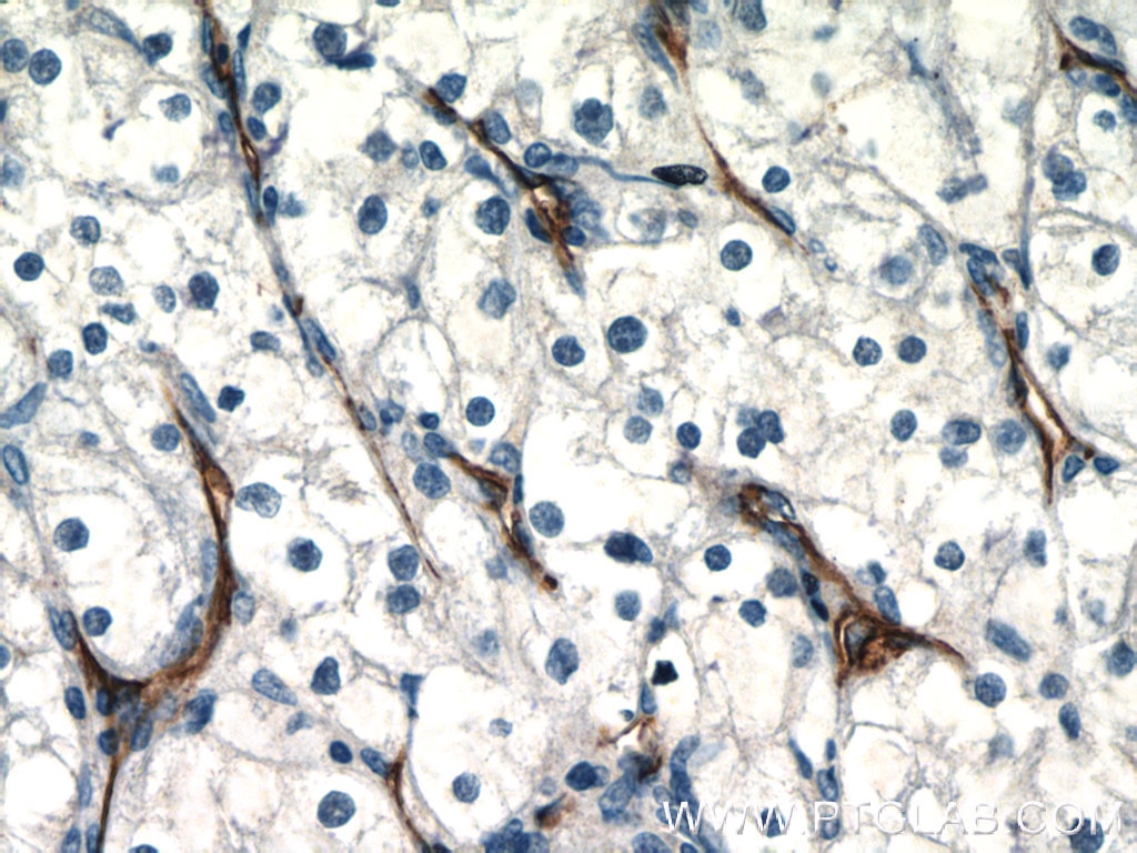 IHC staining of human renal cell carcinoma using 11265-1-AP