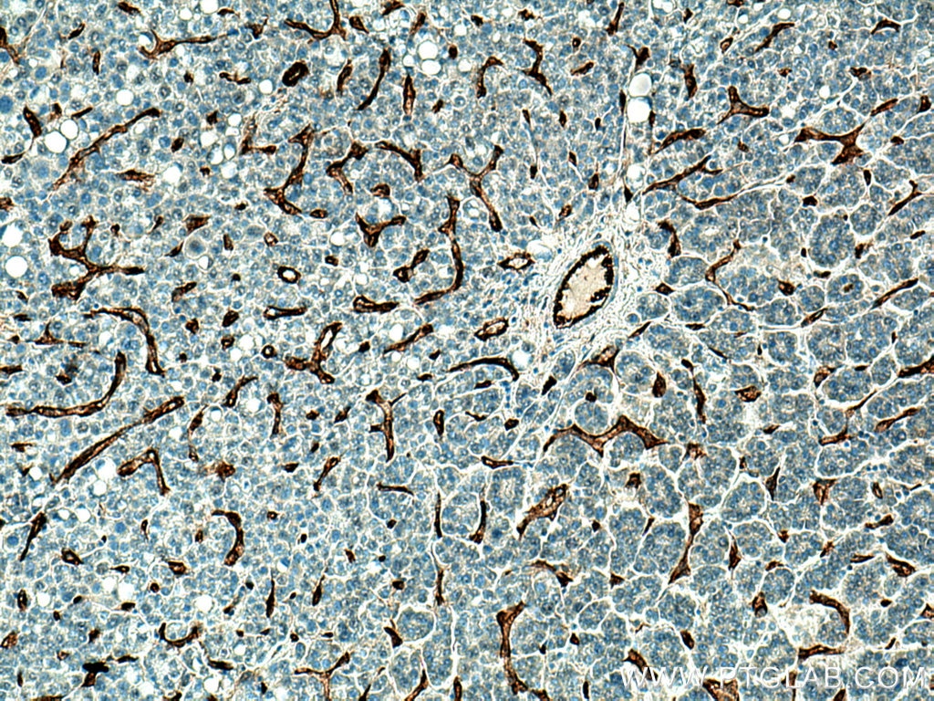 Immunohistochemistry (IHC) staining of human liver cancer tissue using CD31 Polyclonal antibody (11265-1-AP)