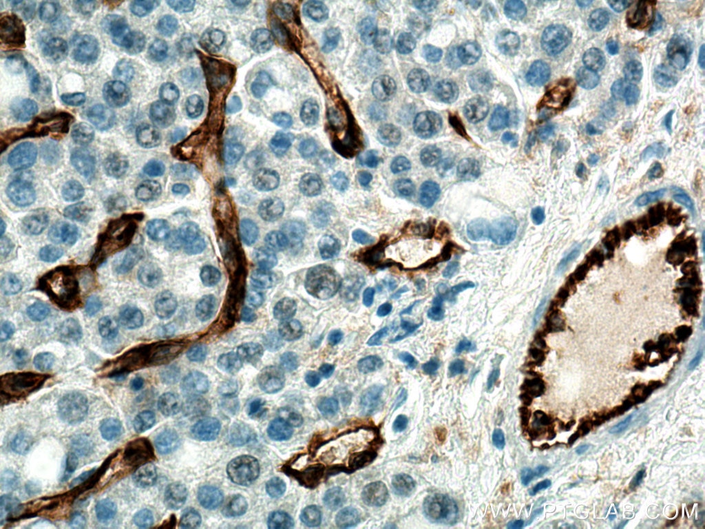 Immunohistochemistry (IHC) staining of human liver cancer tissue using CD31 Polyclonal antibody (11265-1-AP)
