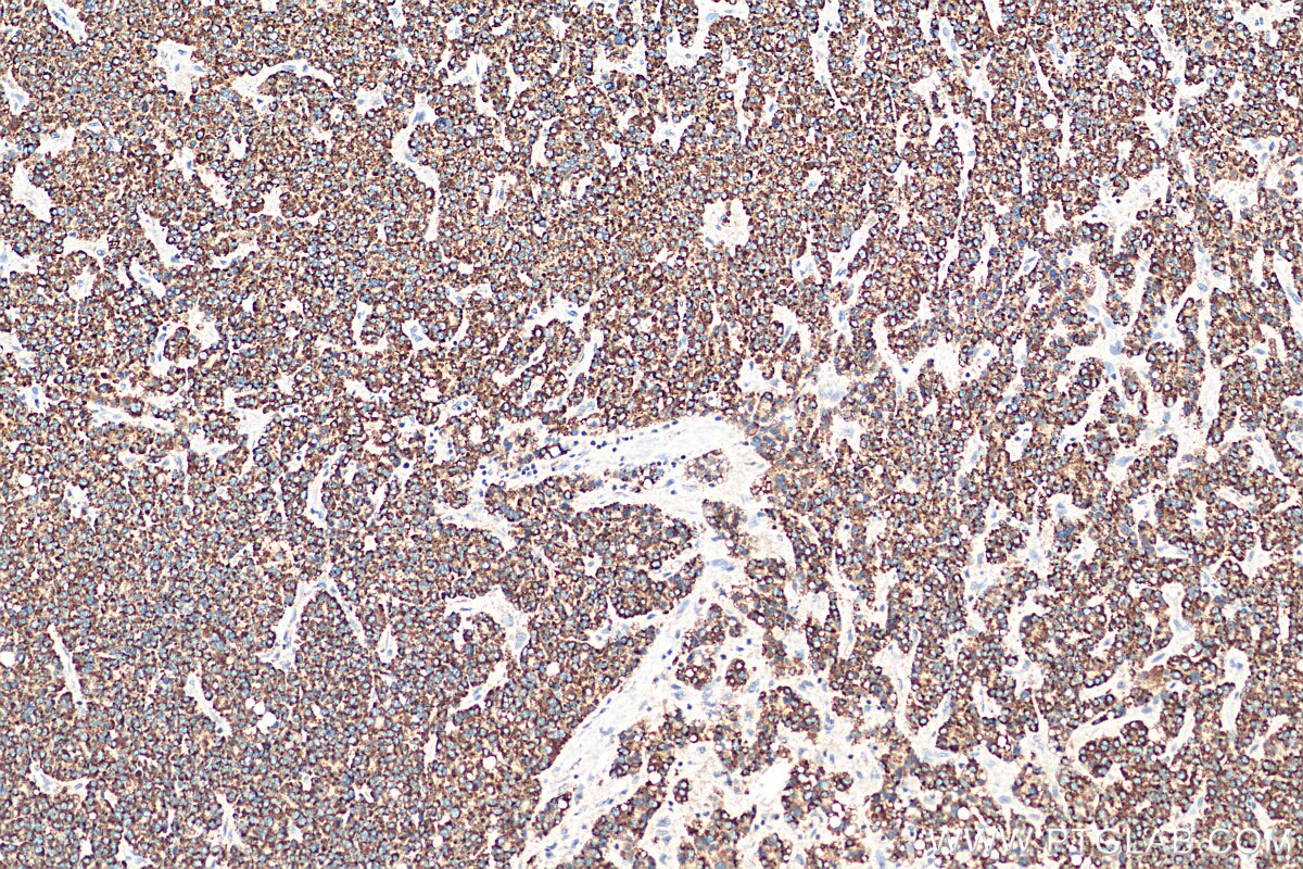 Immunohistochemistry (IHC) staining of human liver cancer tissue using PECR Polyclonal antibody (14901-1-AP)