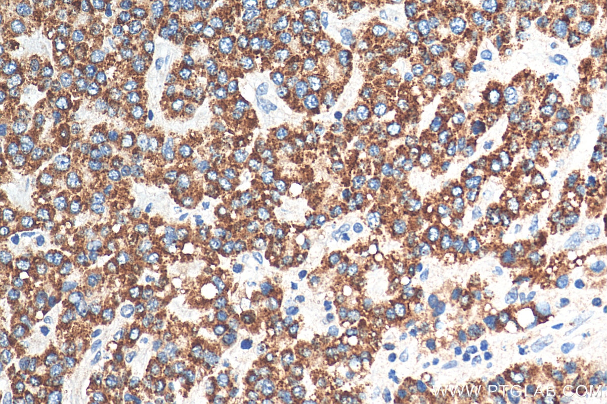 Immunohistochemistry (IHC) staining of human liver cancer tissue using PECR Polyclonal antibody (14901-1-AP)