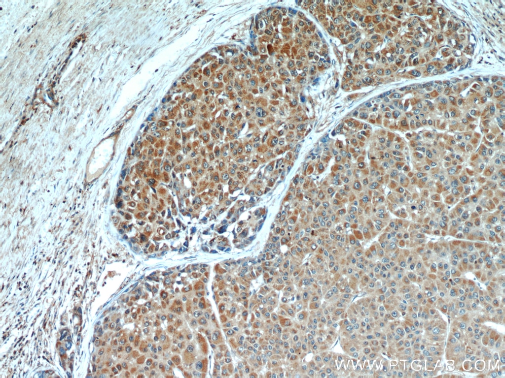 Immunohistochemistry (IHC) staining of human liver cancer tissue using PEG10 Polyclonal antibody (14412-1-AP)