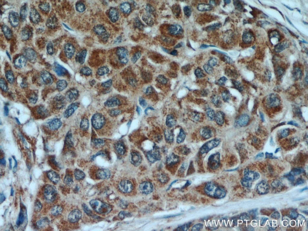 Immunohistochemistry (IHC) staining of human liver cancer tissue using PEG10 Polyclonal antibody (14412-1-AP)