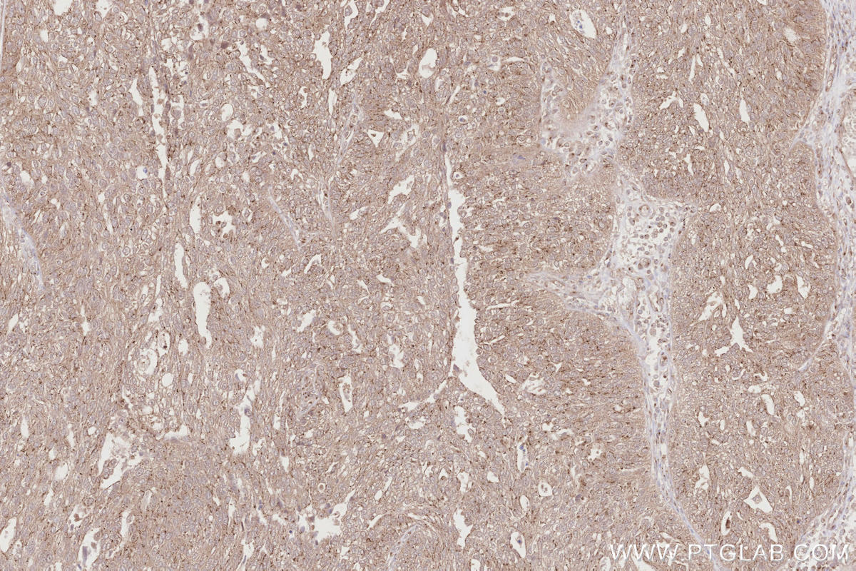 Immunohistochemistry (IHC) staining of human ovary cancer tissue using PELO Polyclonal antibody (10582-1-AP)