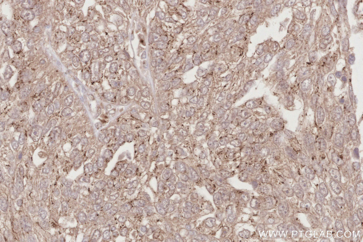 Immunohistochemistry (IHC) staining of human ovary cancer tissue using PELO Polyclonal antibody (10582-1-AP)