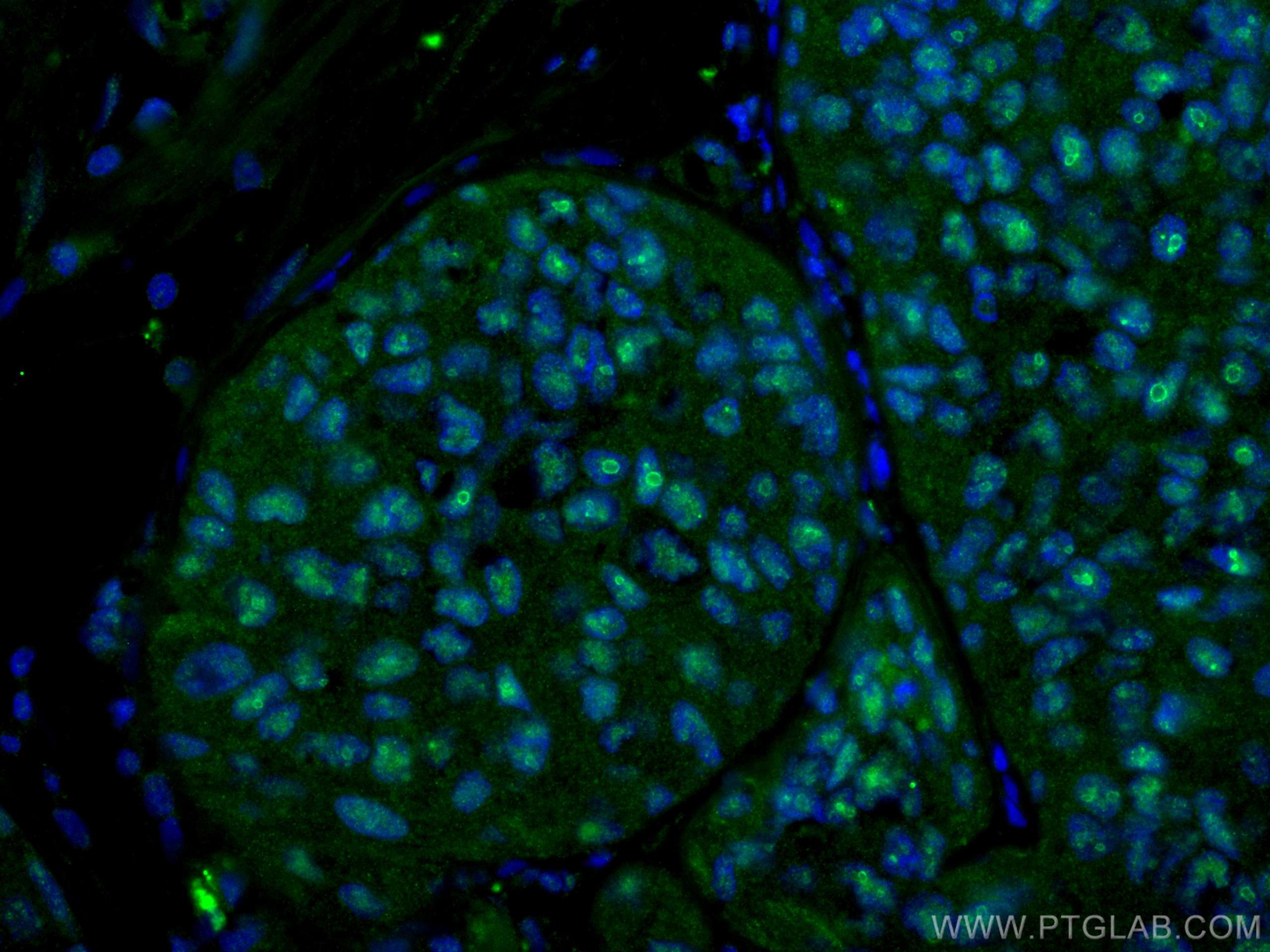 Immunofluorescence (IF) / fluorescent staining of human breast cancer tissue using PELP1 Monoclonal antibody (67050-1-Ig)