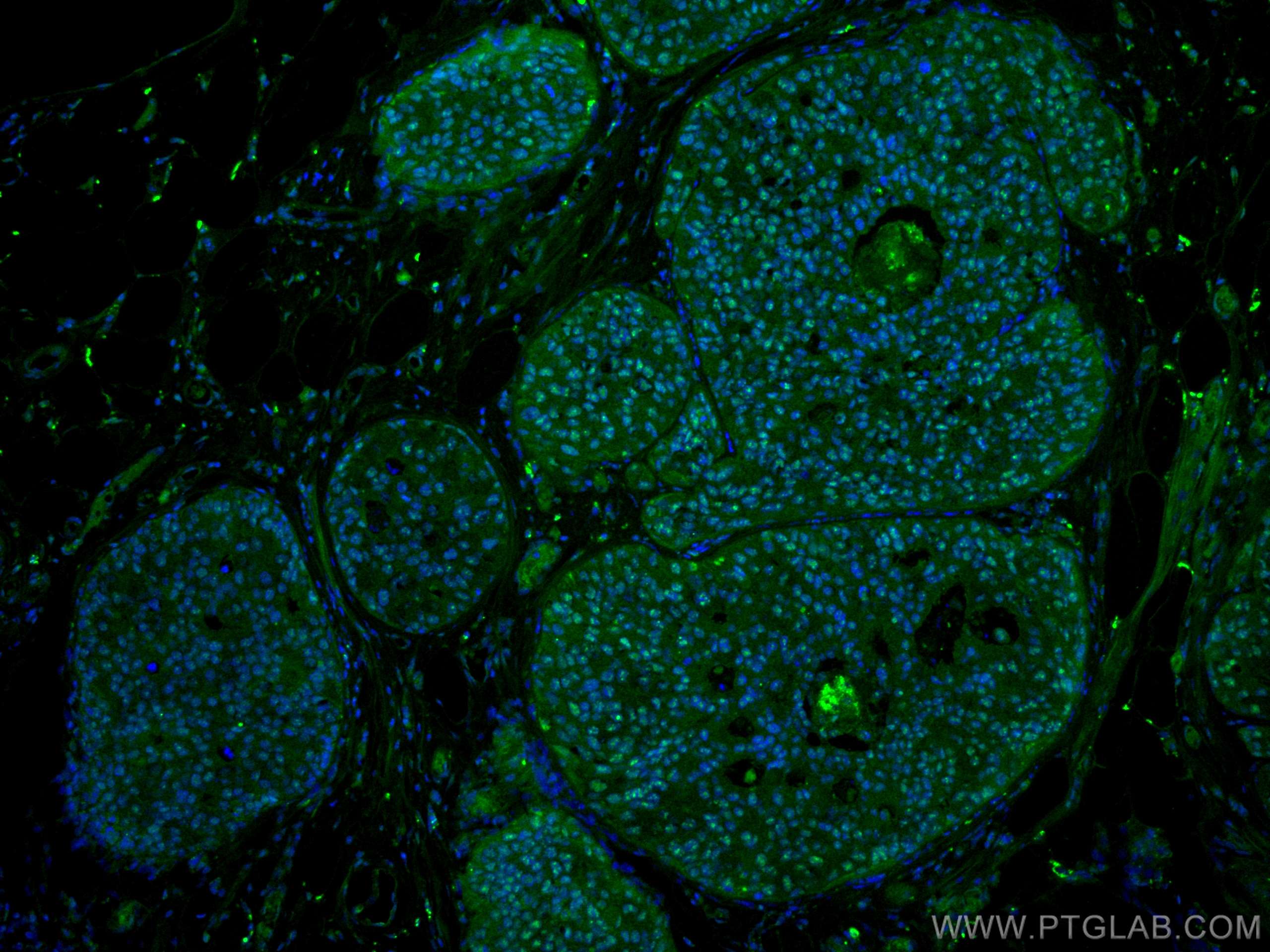 Immunofluorescence (IF) / fluorescent staining of human breast cancer tissue using PELP1 Monoclonal antibody (67050-1-Ig)