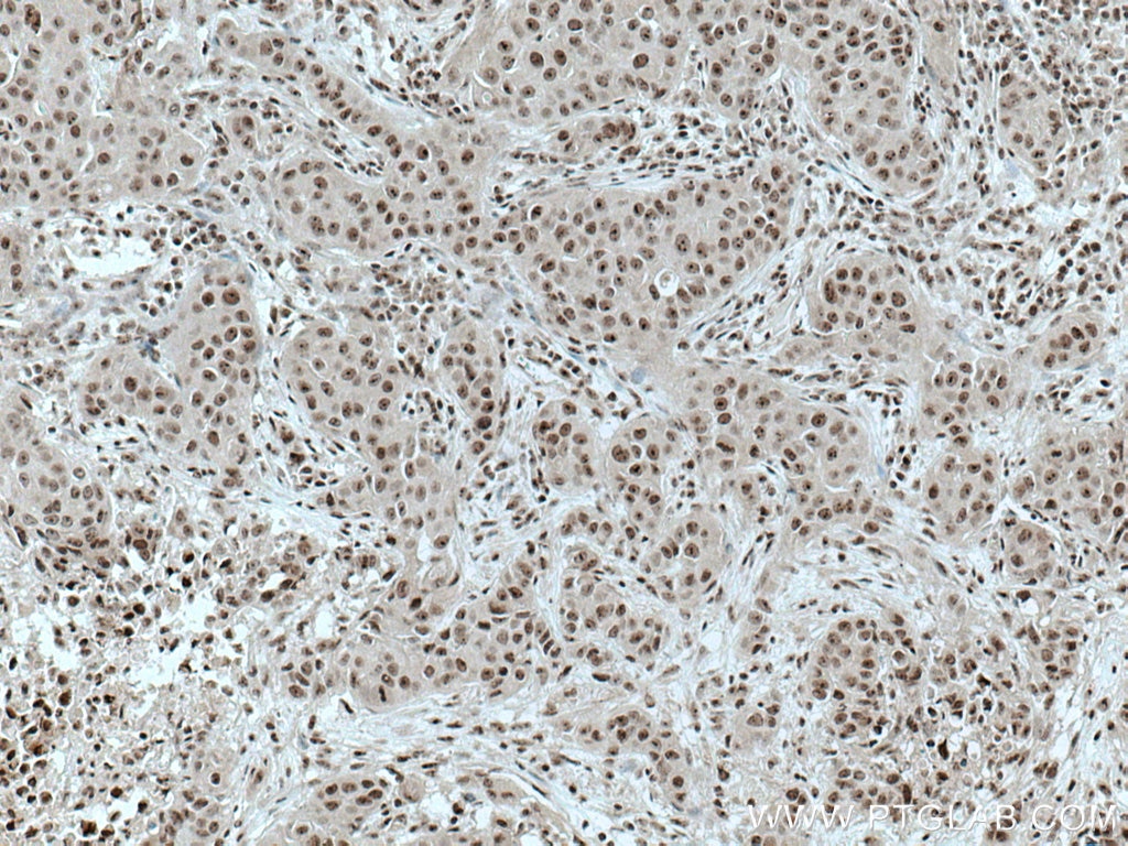 Immunohistochemistry (IHC) staining of human breast cancer tissue using PELP1 Monoclonal antibody (67050-1-Ig)