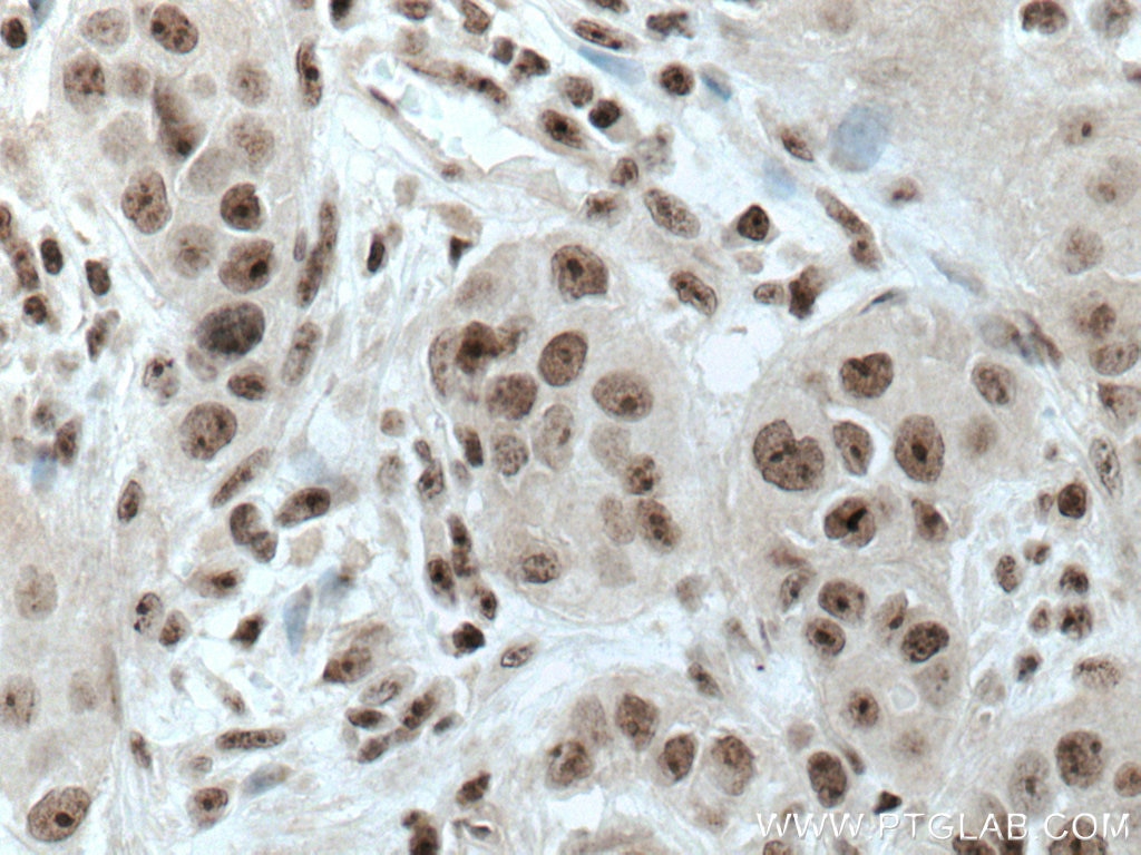 Immunohistochemistry (IHC) staining of human breast cancer tissue using PELP1 Monoclonal antibody (67050-1-Ig)