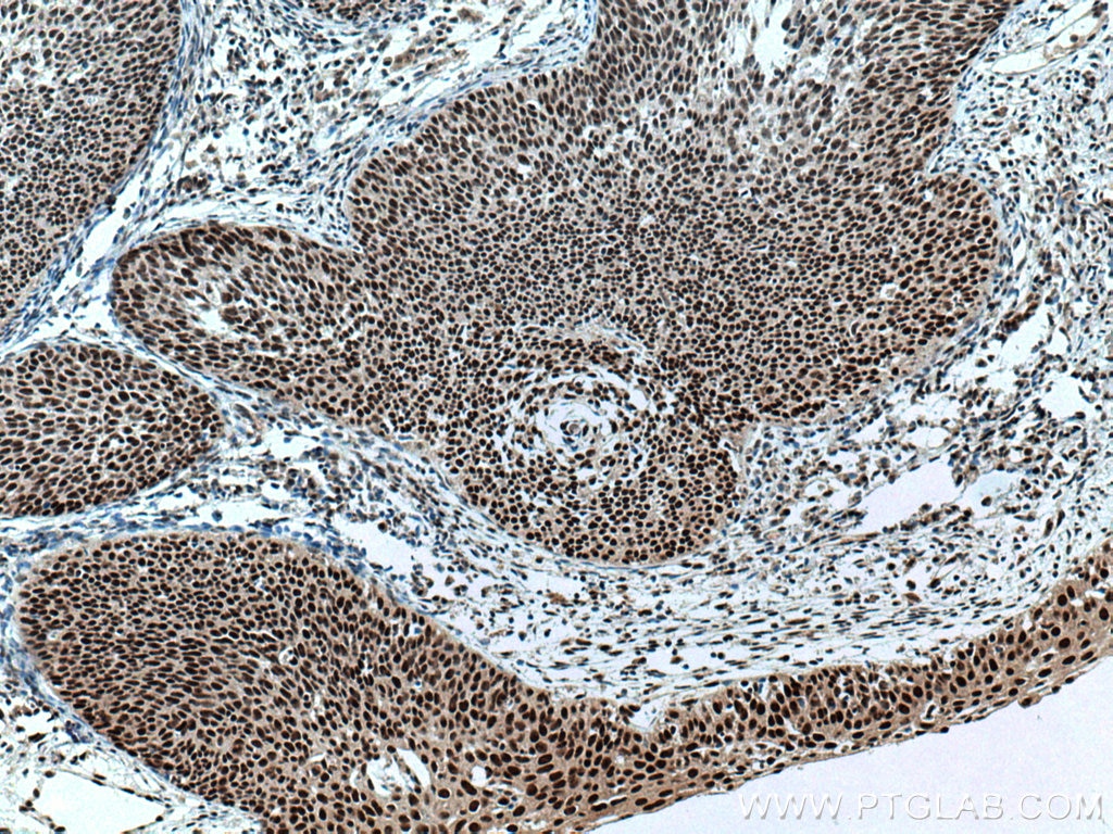 Immunohistochemistry (IHC) staining of human cervical cancer tissue using PELP1 Monoclonal antibody (67050-1-Ig)