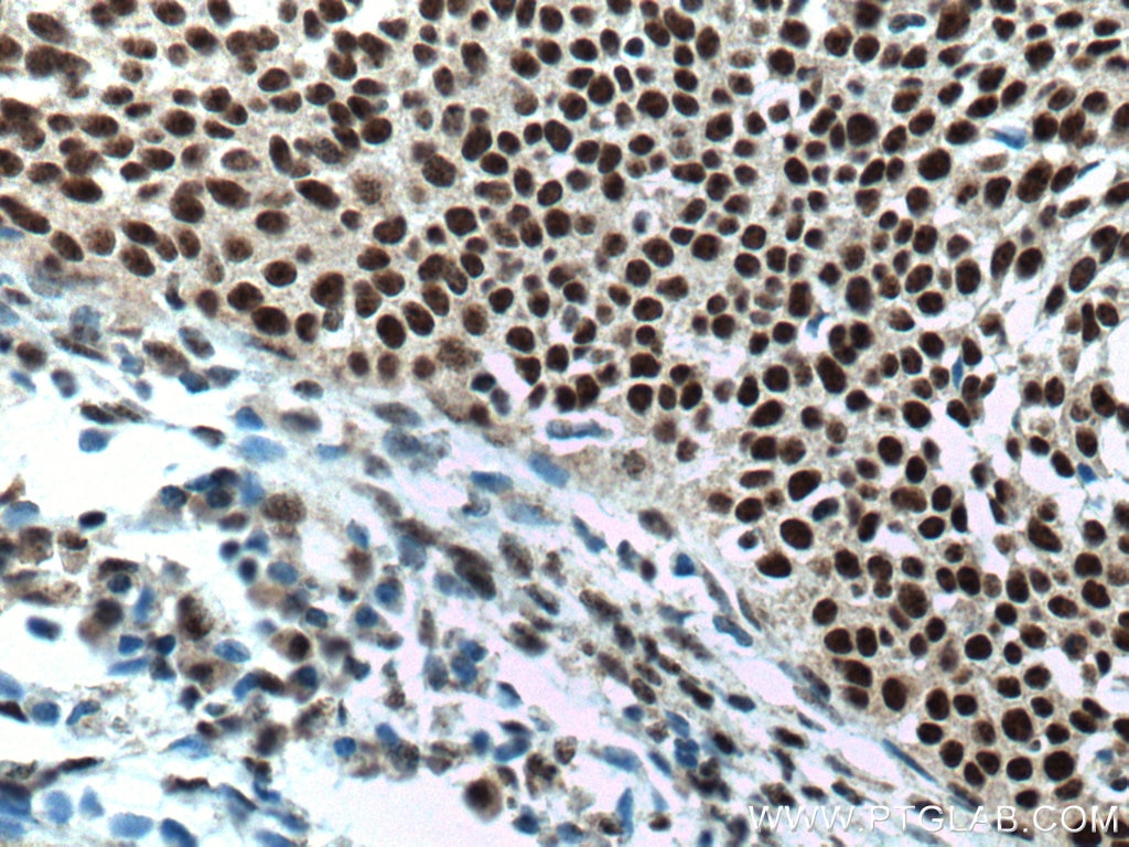 IHC staining of human cervical cancer using 67050-1-Ig