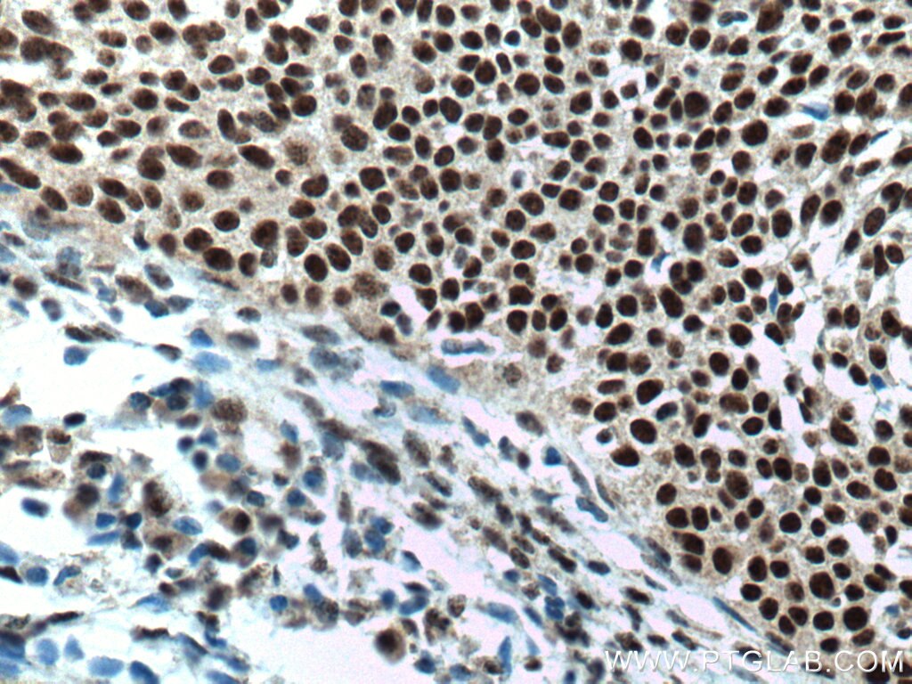 Immunohistochemistry (IHC) staining of human cervical cancer tissue using PELP1 Monoclonal antibody (67050-1-Ig)