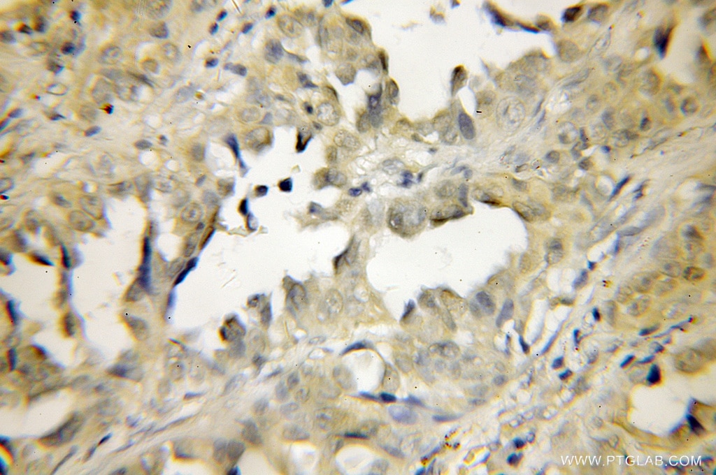 Immunohistochemistry (IHC) staining of human lung cancer tissue using PEPD Polyclonal antibody (12218-1-AP)