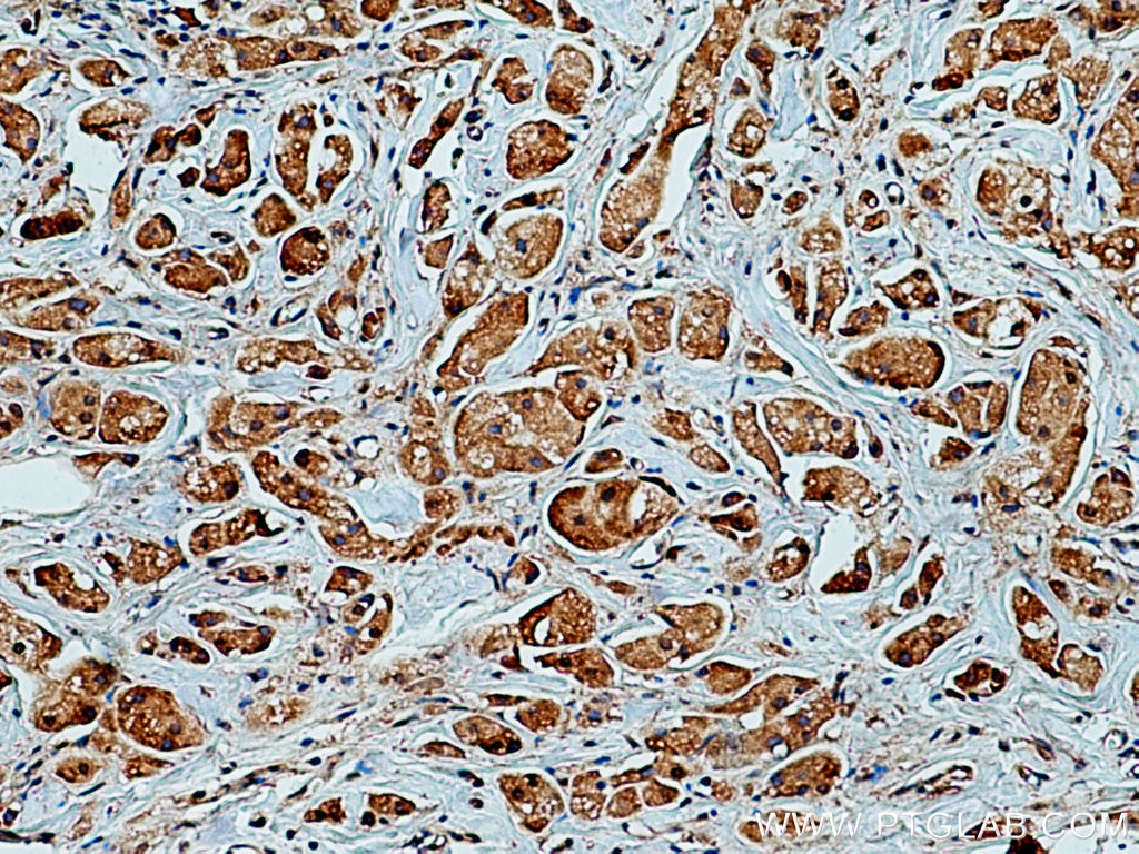Immunohistochemistry (IHC) staining of human breast cancer tissue using PEPD Monoclonal antibody (67202-1-Ig)