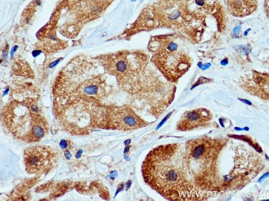 Immunohistochemistry (IHC) staining of human breast cancer tissue using PEPD Monoclonal antibody (67202-1-Ig)