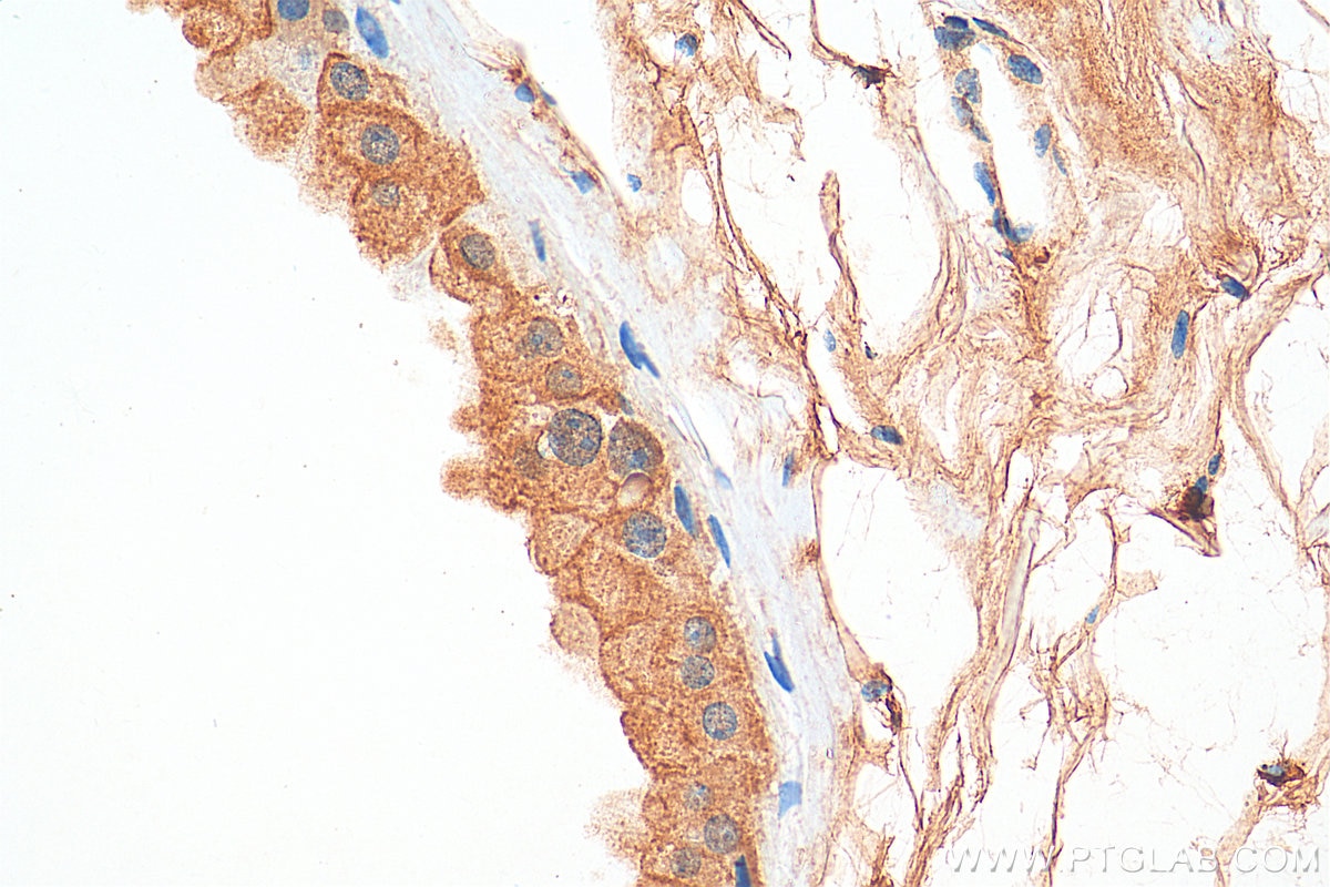 Immunohistochemistry (IHC) staining of human breast cancer tissue using PER1 Polyclonal antibody (13463-1-AP)