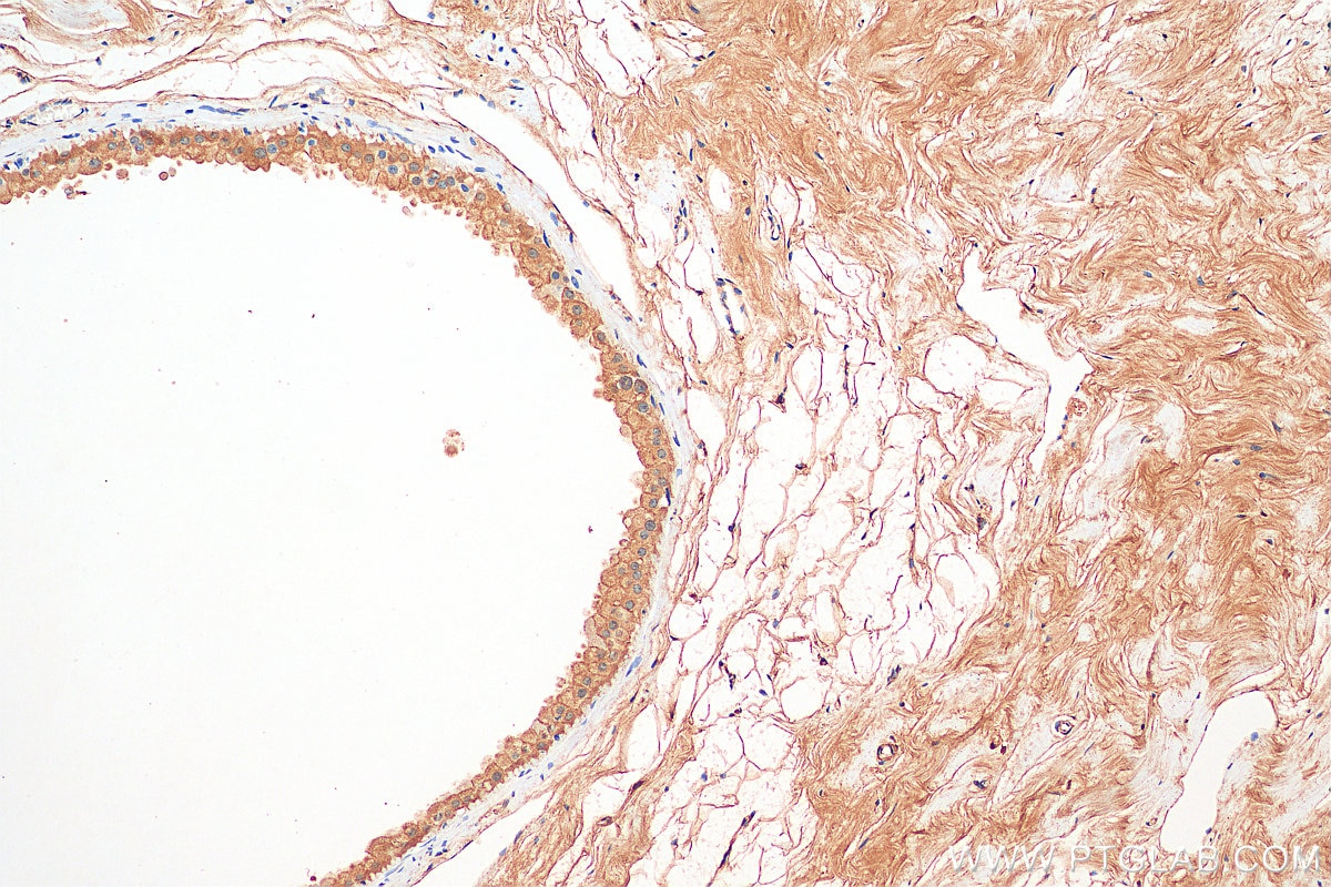 Immunohistochemistry (IHC) staining of human breast cancer tissue using PER1 Polyclonal antibody (13463-1-AP)