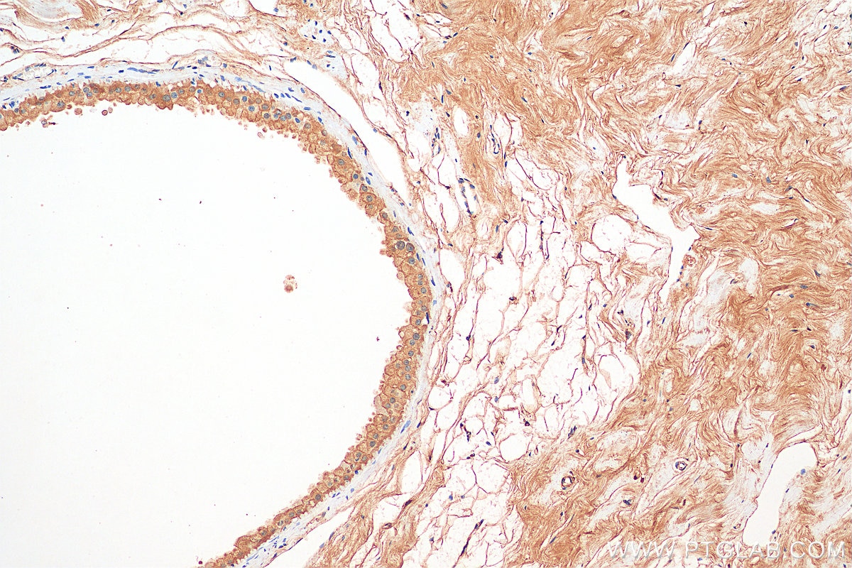 IHC staining of human breast cancer using 13463-1-AP