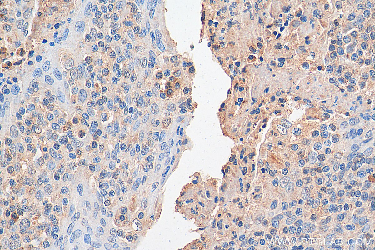 Immunohistochemistry (IHC) staining of human tonsillitis tissue using PER1 Polyclonal antibody (13463-1-AP)