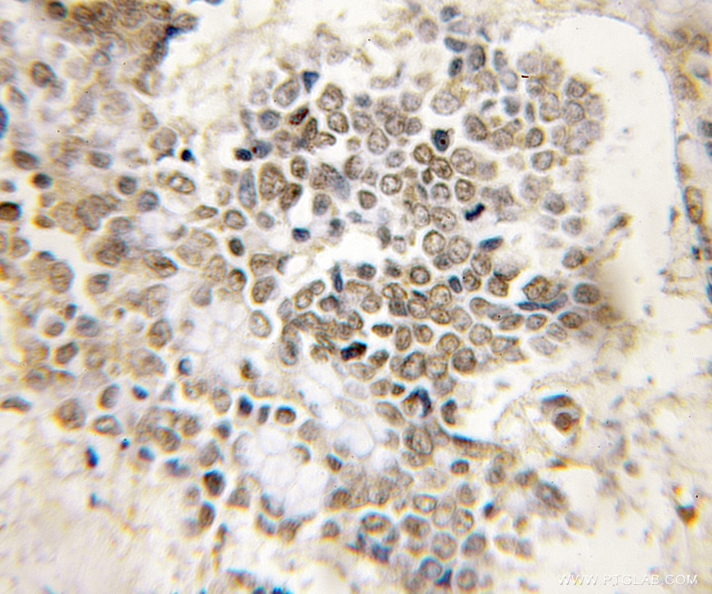Immunohistochemistry (IHC) staining of human colon cancer tissue using PER3 Polyclonal antibody (12550-1-AP)