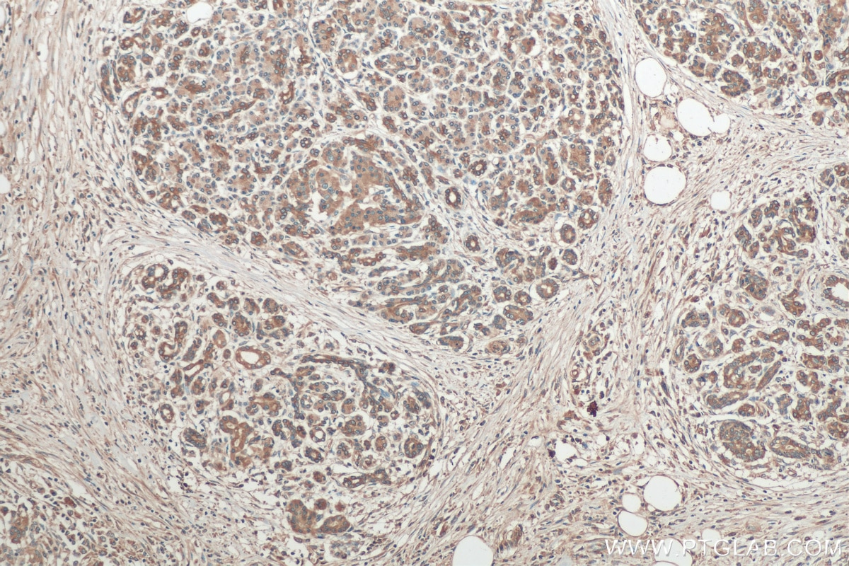 Immunohistochemistry (IHC) staining of human pancreas cancer tissue using PERK/EIF2AK3 Polyclonal antibody (20582-1-AP)