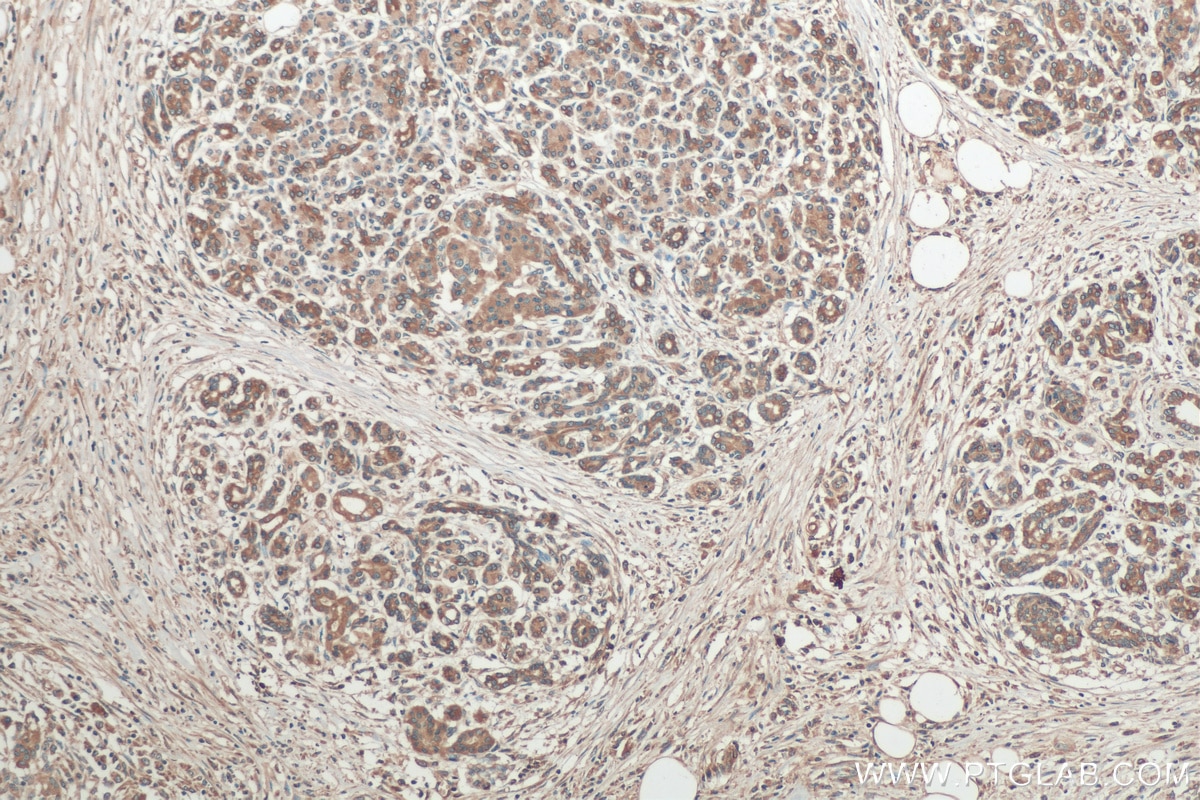 IHC staining of human pancreas cancer using 20582-1-AP