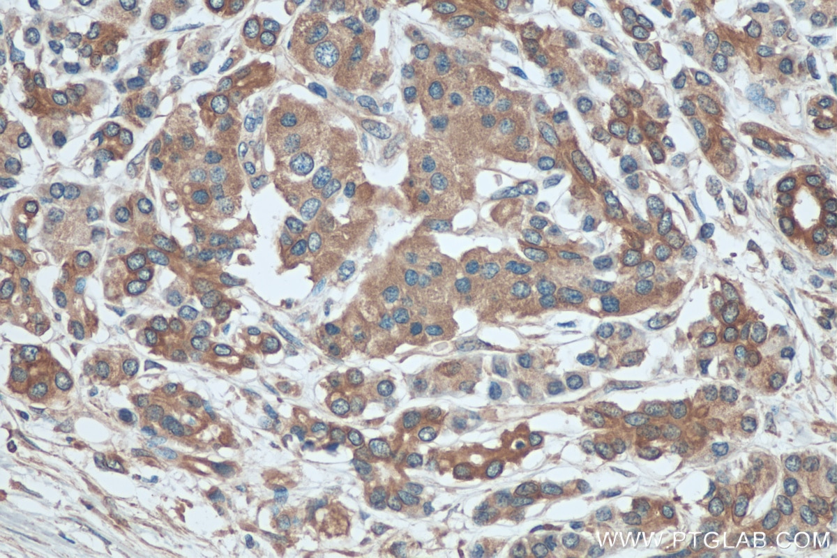 Immunohistochemistry (IHC) staining of human pancreas cancer tissue using PERK/EIF2AK3 Polyclonal antibody (20582-1-AP)